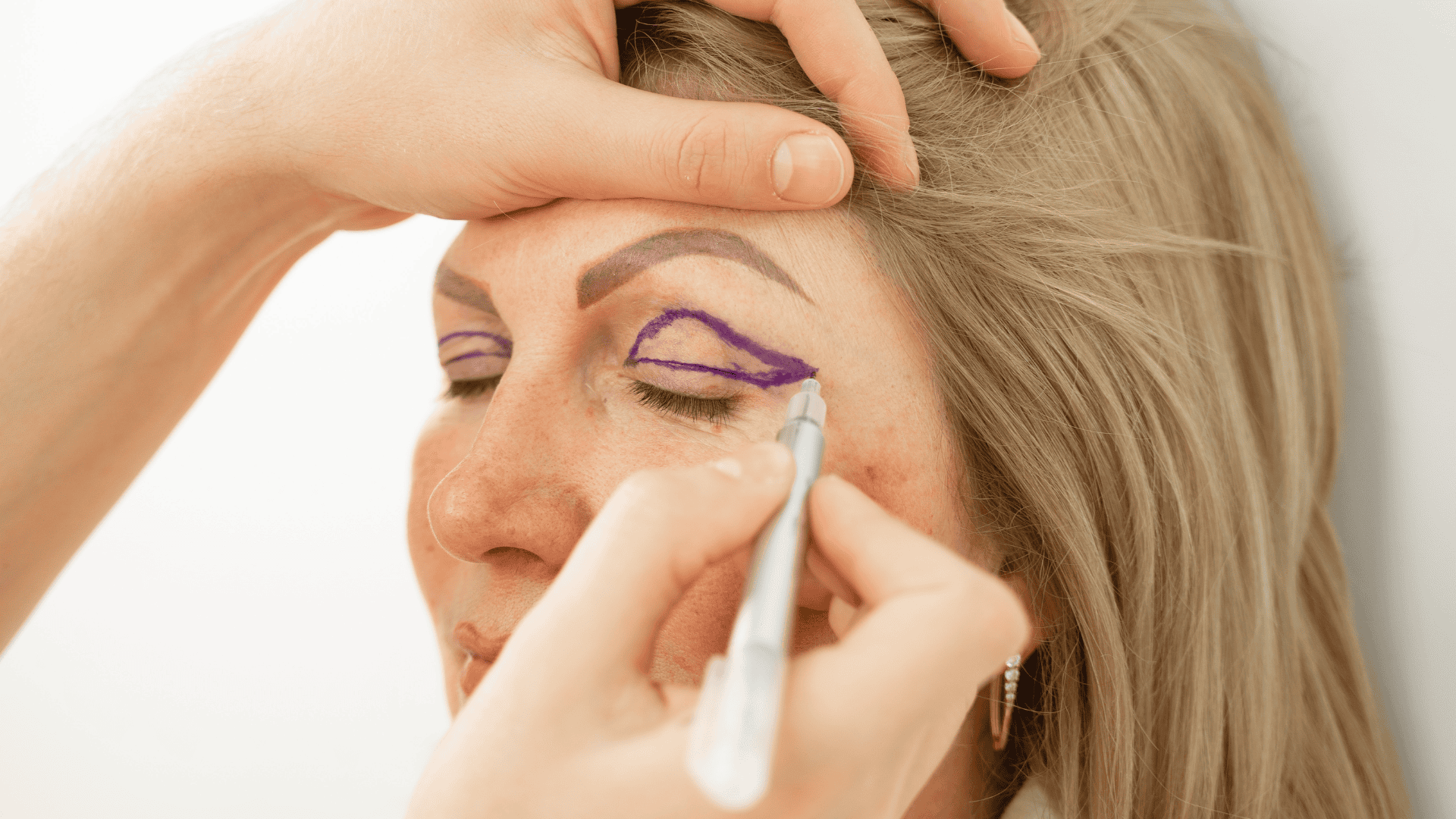 Blefaroplastia: Tudo o que precisa saber sobre esta intervenção estética ocular