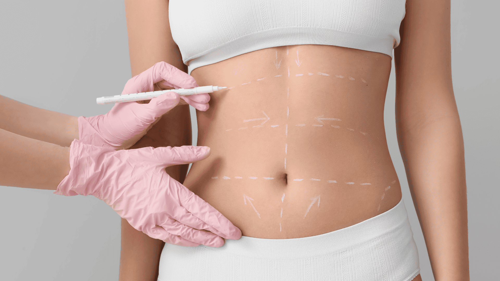 Mini-abdominoplastiek