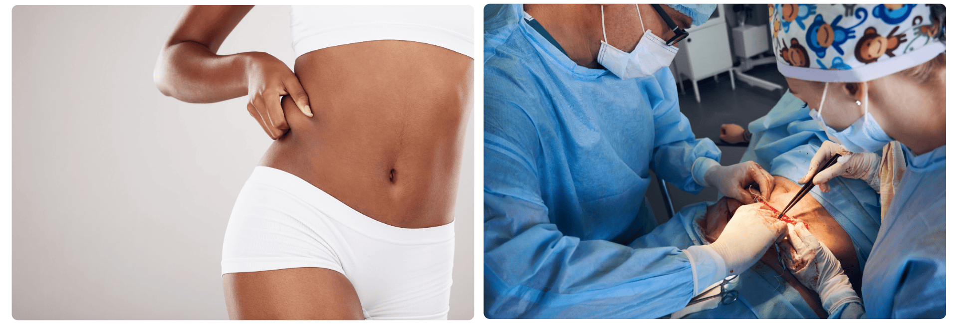 tummy tuck (2).png